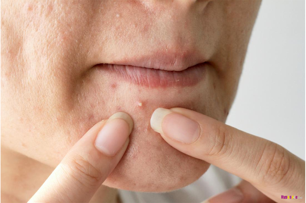 How popping a pimple, on your face can kill you