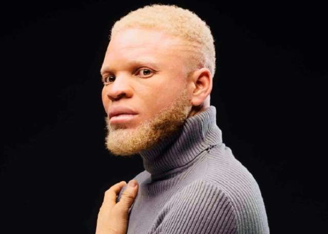 I was abandoned at birth by my father when he saw I was an albino – Byno