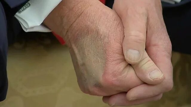 Trump Diagnosed With Chronic Venous Insufficiency After Experiencing Leg Swelling
