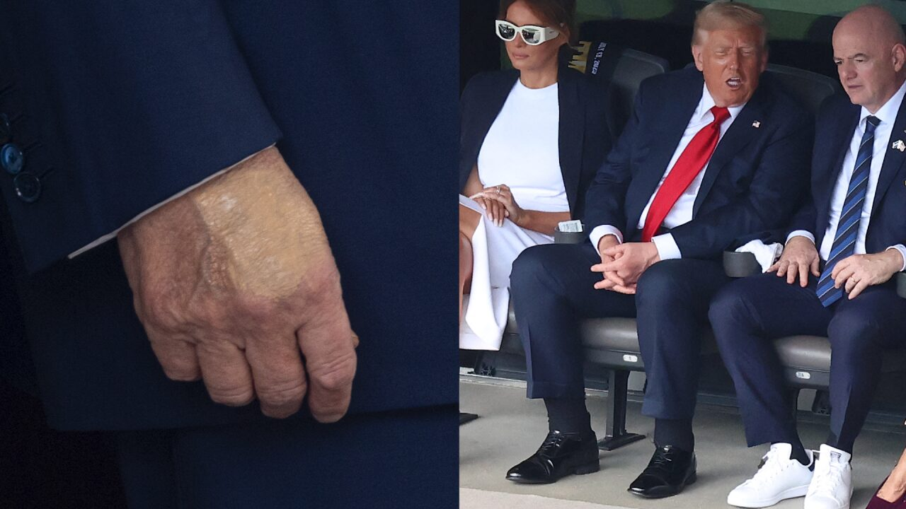 Trump Diagnosed With Chronic Venous Insufficiency After Experiencing Leg Swelling
